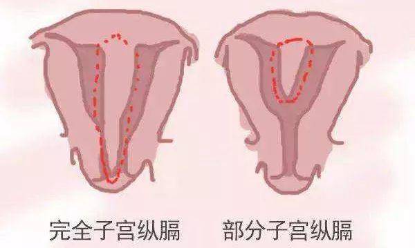 拥有双子宫的女人可以怀孕吗?会影响正常生活吗?