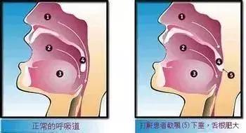 打呼噜就是睡得香？其实有可能会要人命！