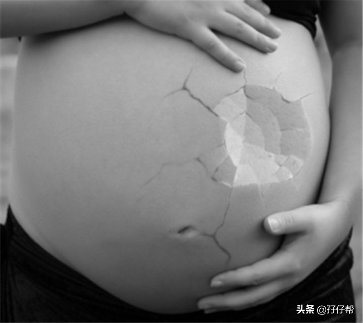 比青春还痛的是，怀上双胞胎的我长妊娠纹了