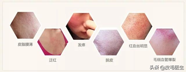 皮肤敏感属于什么皮肤,皮肤敏感的原因和治疗方法