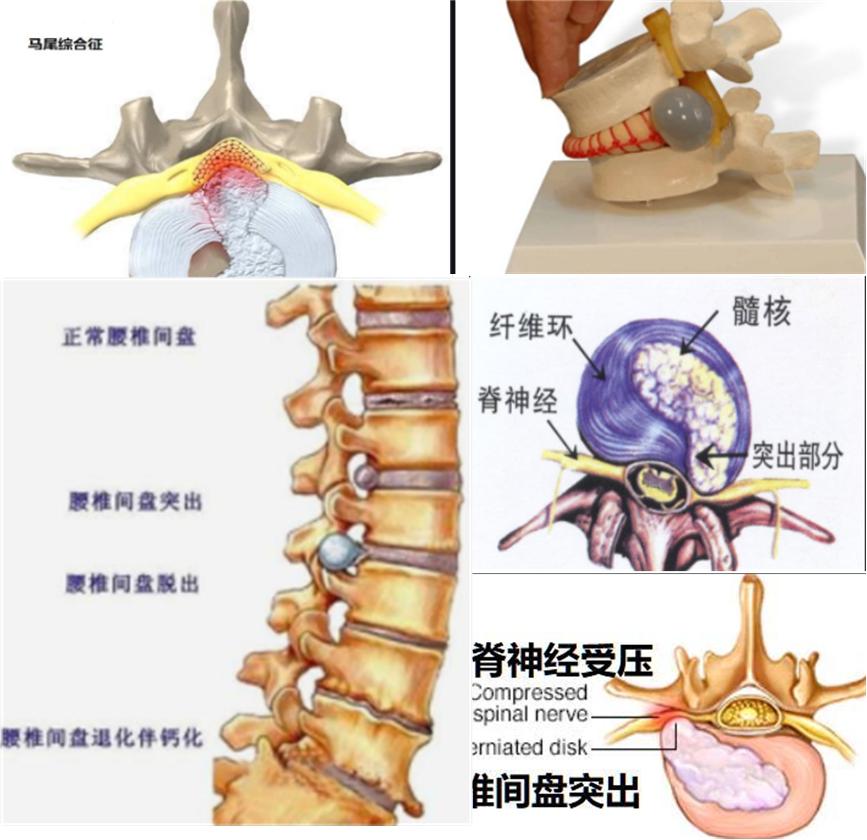 腰椎间盘突出腰腿痛平时锻炼方法,腰椎间盘突出脚麻疼痛怎么缓解