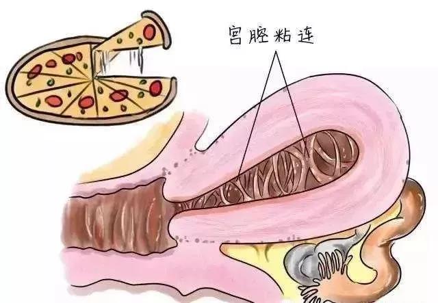 子宫切口憩室二次剖宫产,剖腹产手术十年后子宫内膜异位