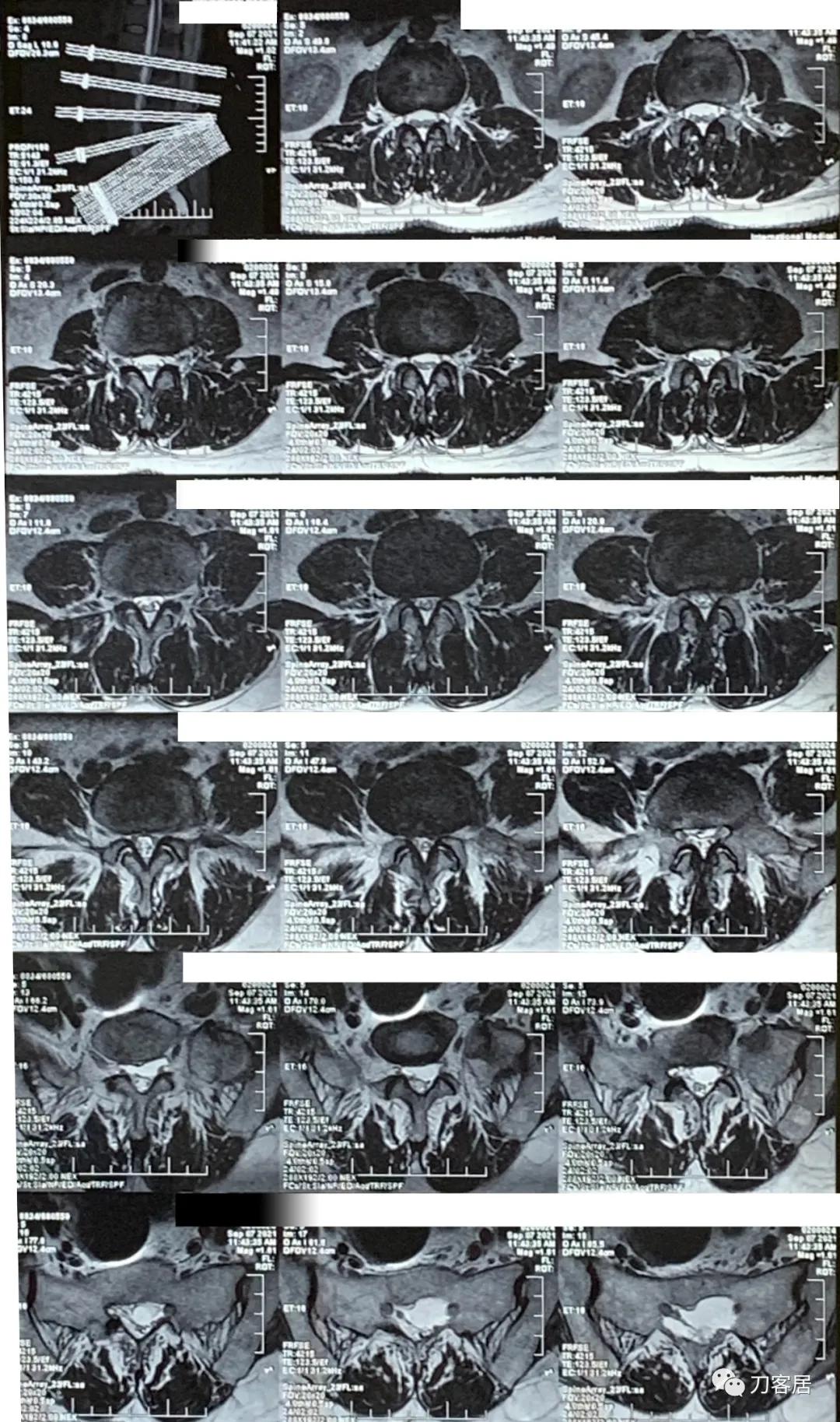 左下肢疼痛病历,门诊腹痛病历