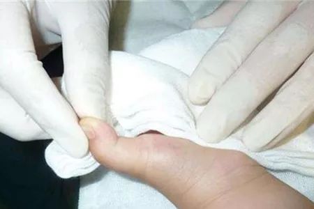 怎样预防类风湿性关节炎,类风湿关节炎手指发麻要怎么预防