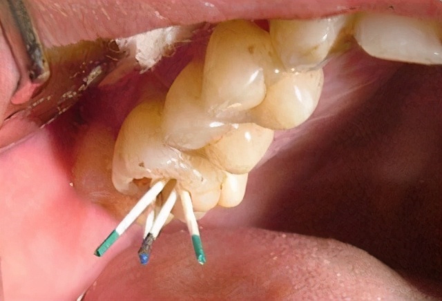 这些都能导致严重的牙疼，可以这样治疗？#雅悦齿科#