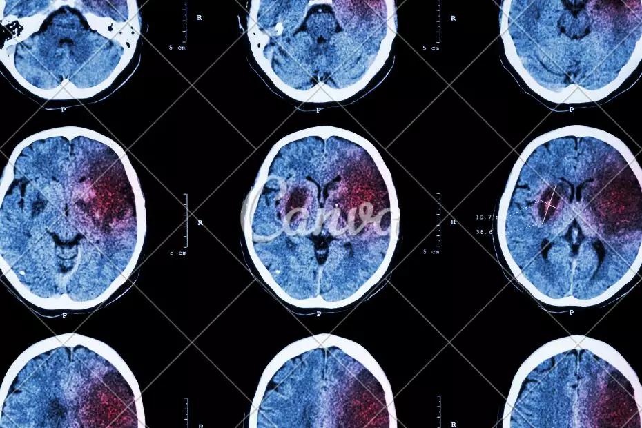 黄帝内针如何有效调理脑中风？