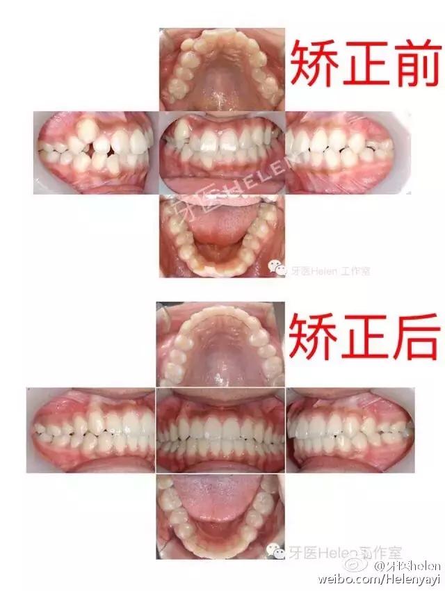 德国牙齿隐形矫正,牙科隐形矫正科普