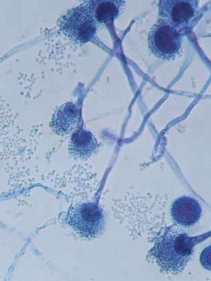 霉菌是什么病图片,霉菌是啥