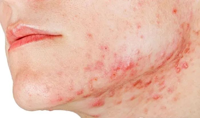 十大爆痘神器排行榜,战痘神器效果怎么样