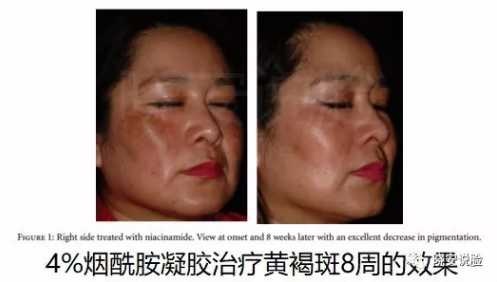 烟酰胺olay小白瓶美白效果,olay小白瓶烟酰胺提亮美白