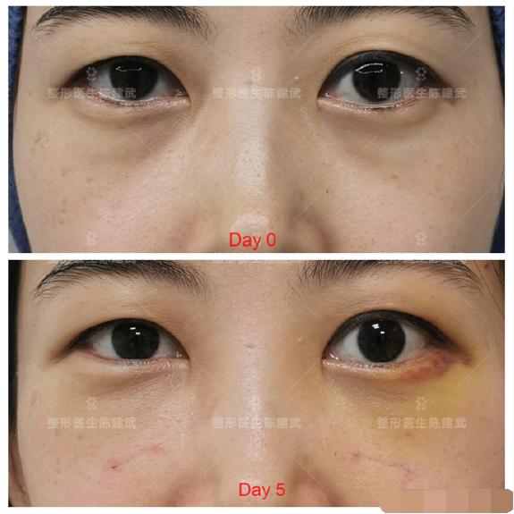 做完眼袋手术有淤青发黑怎么回事,做完眼袋手术有淤青图片