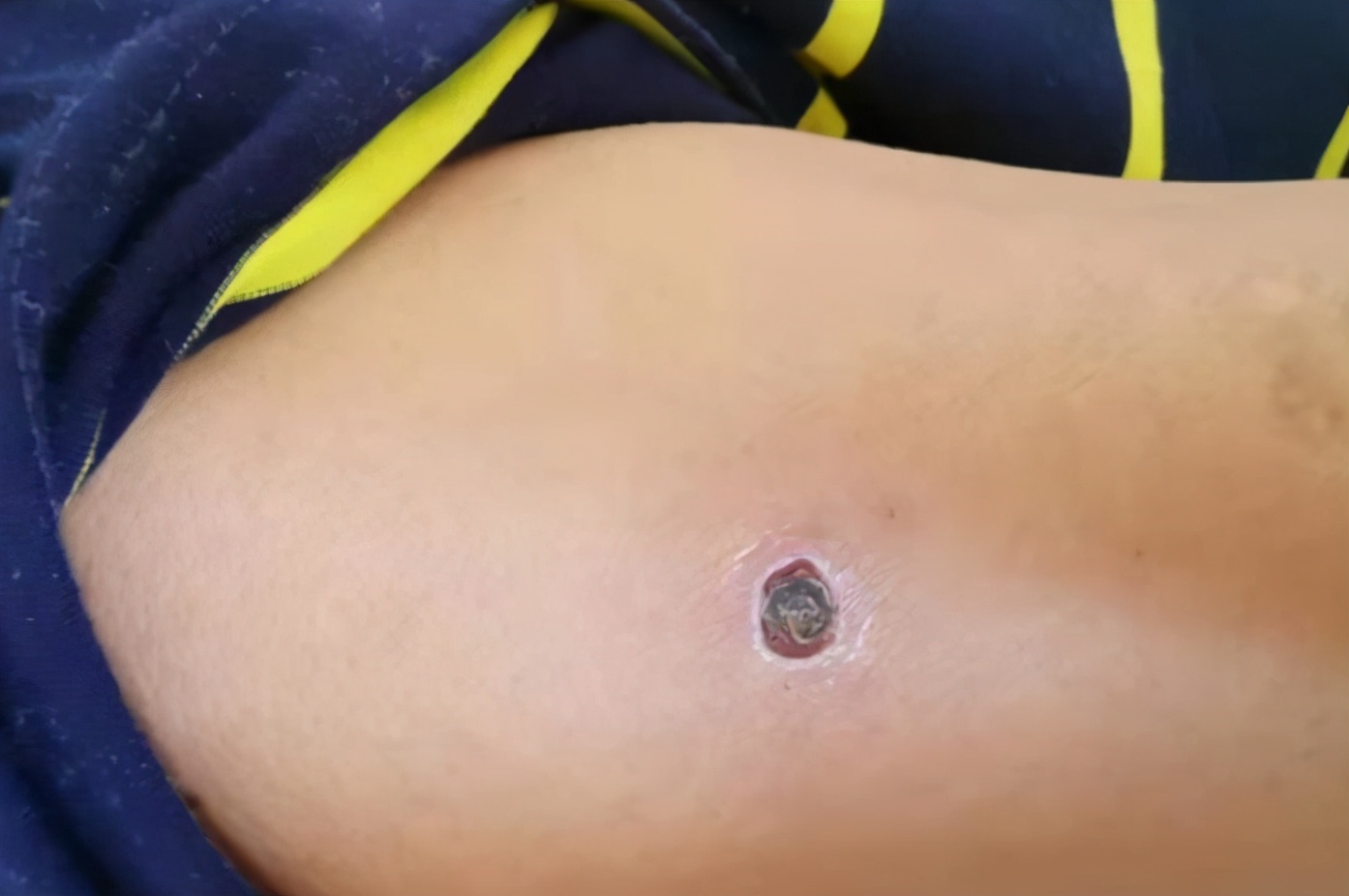 高烧10天反复不退怎么办,高烧不退身上起疙瘩像蚊子咬