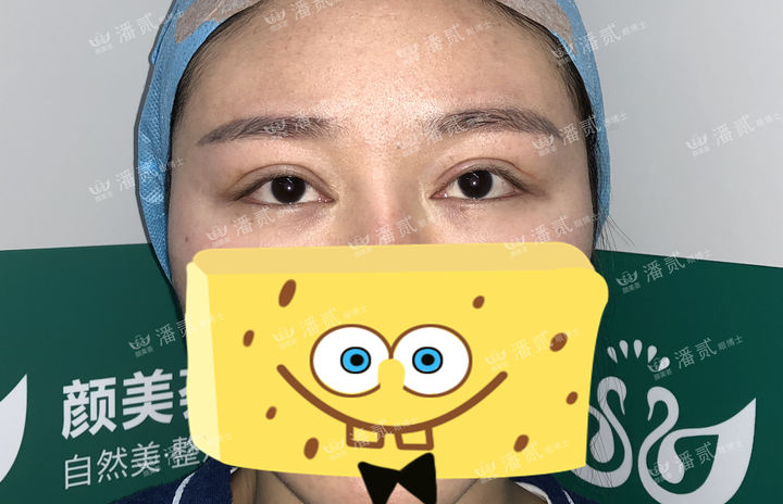 开眼角过大图片,开眼角过大修复效果图