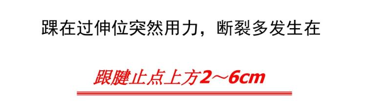 跟腱自发性断裂,跟腱断裂全负重行走