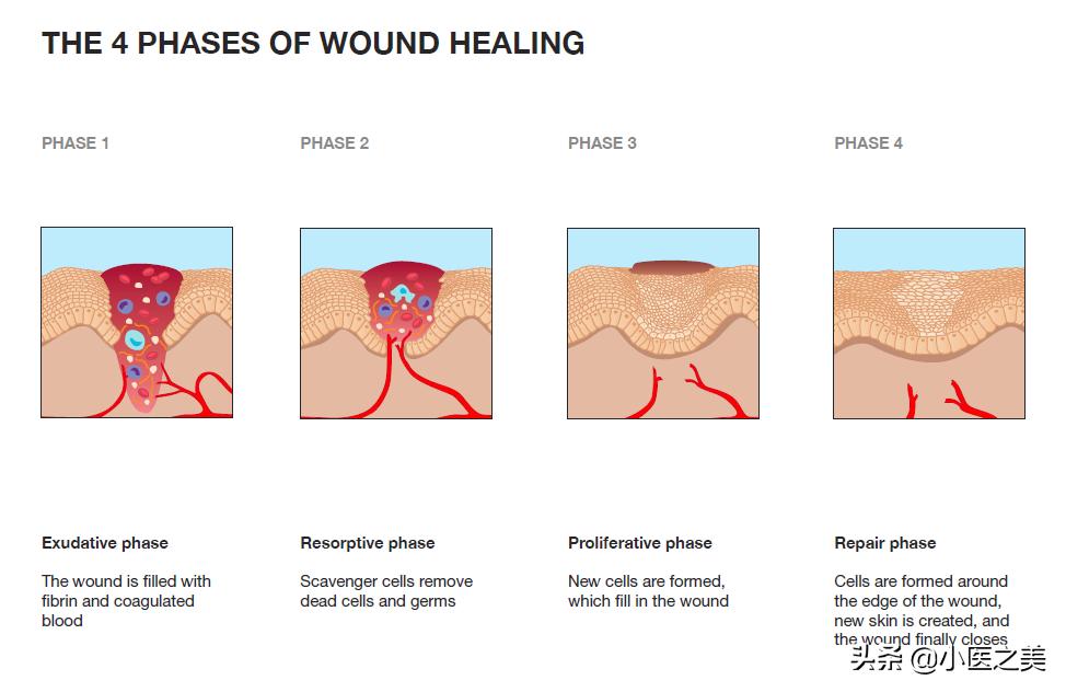 烫伤,以正确的方式治疗可帮助减轻疤痕增生