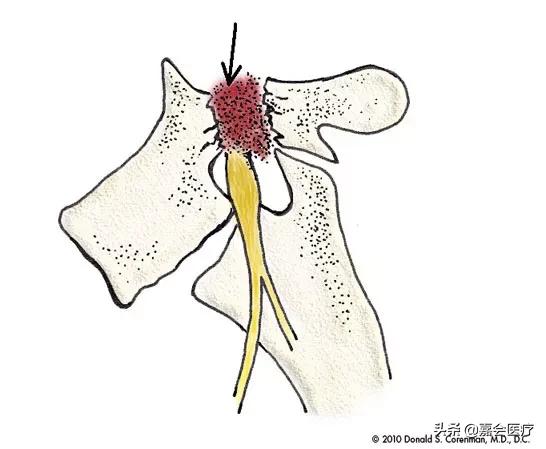 腰痛是不是因为驼背,腰两侧椎弓崩裂什么引起的