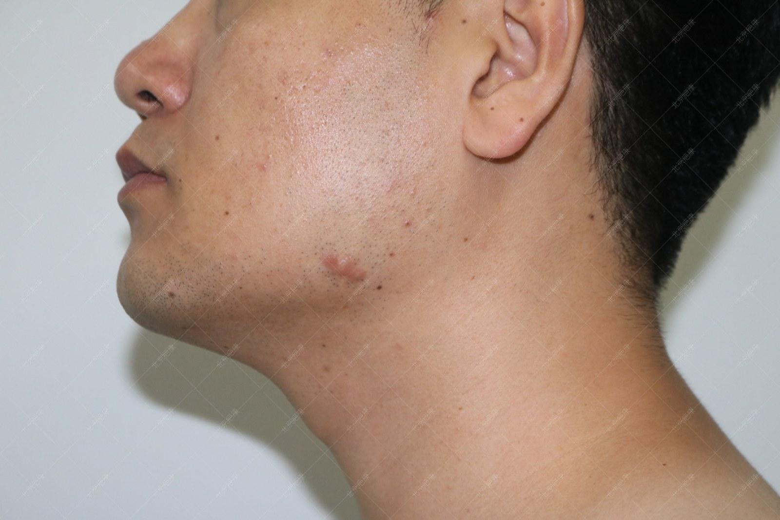 疤康医疗治疤痕疙瘩靠谱吗,乐疤康祛除疤痕有效果吗