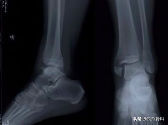 陈旧性踝关节损伤的治疗,踝关节损伤现场处理视频