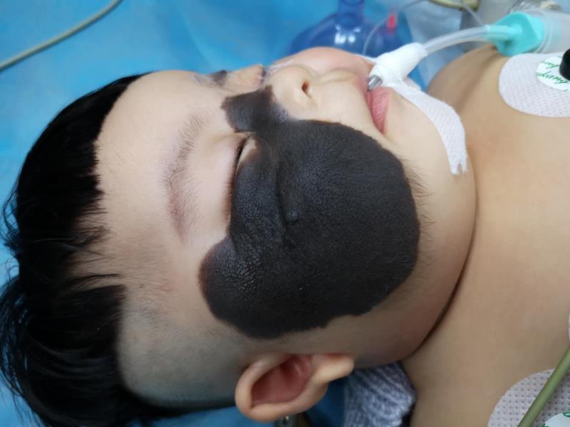 孩子黑毛痣去除,孩子黑毛痣应该挂什么科