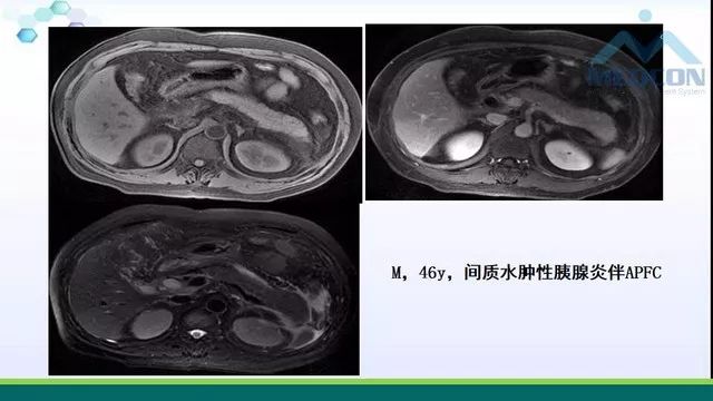 急性胰腺炎的护理措施,急性胰腺炎影像与临床