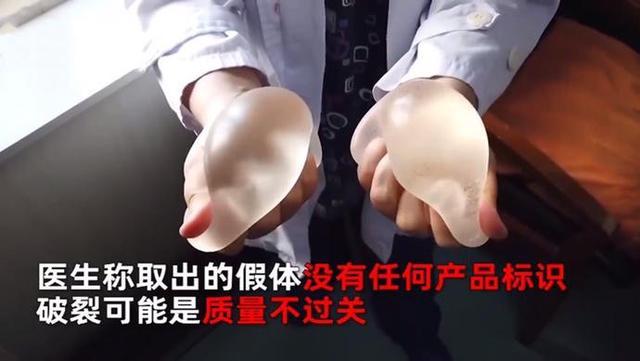 假体隆胸坏死,女子隆胸30年的假体突然破