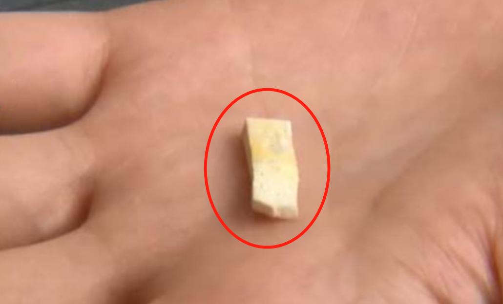 打个喷嚏鼻子假体掉出来了,打了个喷嚏堵在鼻子里了