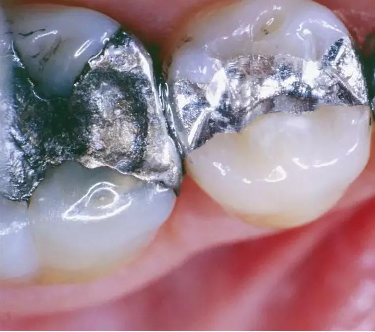 牙疼补牙的流程及步骤,补牙牙痛最好在哪里治疗