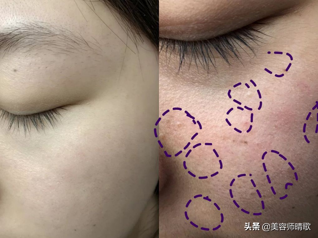 长斑应该注意的饮食事项,长斑的过程你了解了吗