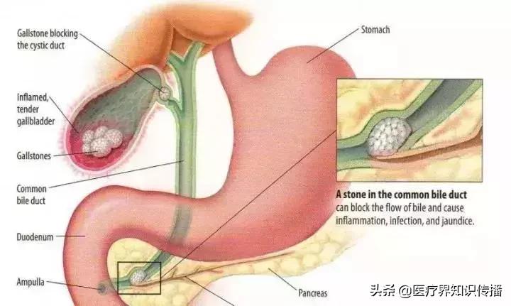 胆囊切除后吃什么植物油炒菜好,胆囊切除后吃油多了是什么症状