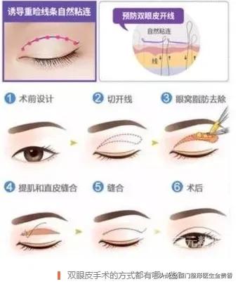 纳米无痕埋线双眼皮需不需要拆线,纳米无痕双眼皮动画操作过程视频