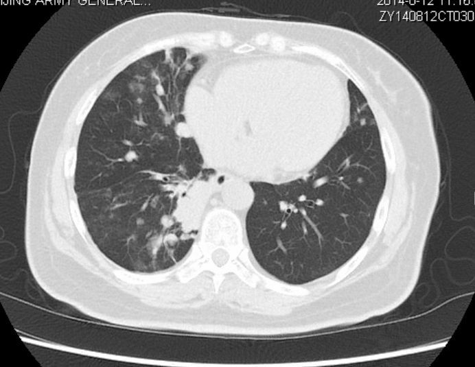 黏液腺癌基本不转移不复发,肺粘液腺癌转移了还能治好吗