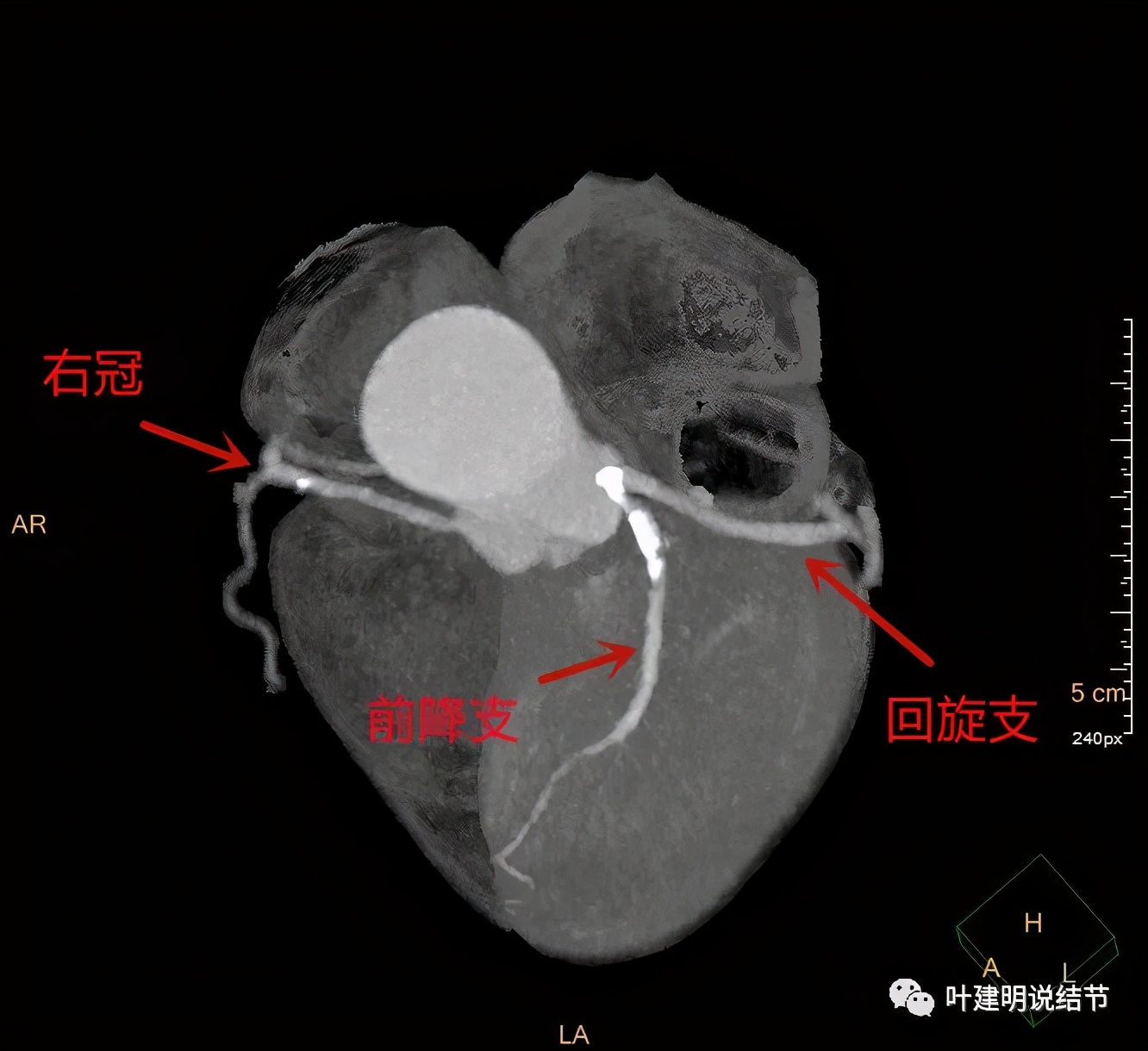胸部高分辨ct检查注意事项,胸部ct扫描有没有危害