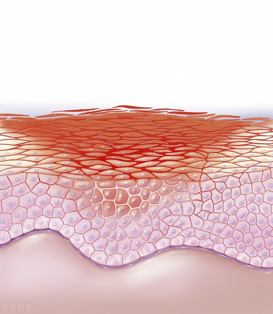 湿疹总是不好吃什么药,湿疹总是不好也不是过敏怎么回事