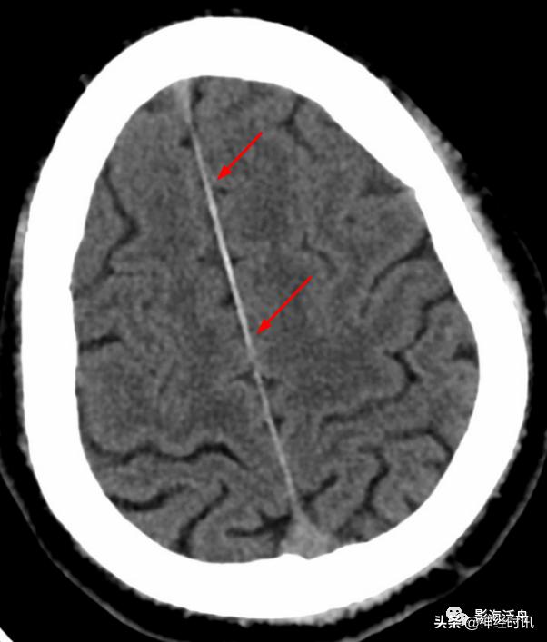 蛛血的临床表现,蛛血ct表现