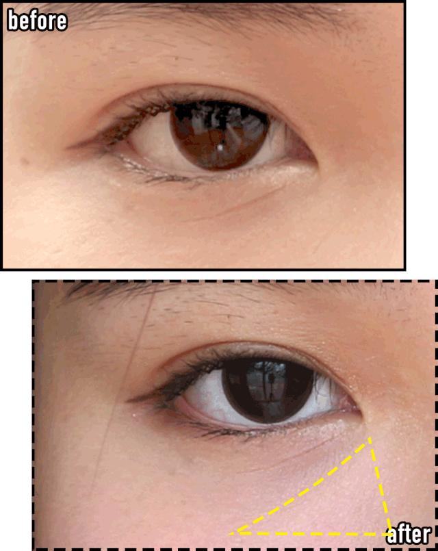 花10万打玻尿酸经验总结,花了将近十万打玻尿酸没有效果