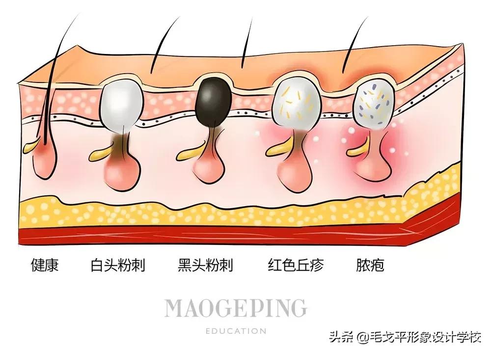 什么药能有效祛黑头治草莓鼻,草莓鼻清理黑头神器