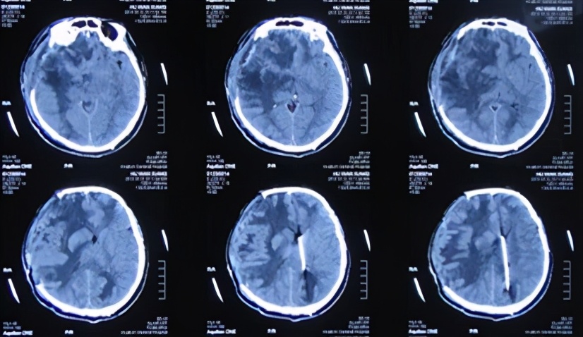 脑外伤开颅手术后脑积水,脑外伤手术后脑脊液鼻漏怎么治疗