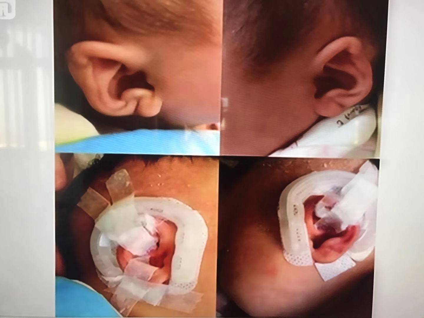 耳朵软骨畸形能矫正吗,新生儿耳朵畸形矫正费用大概多少