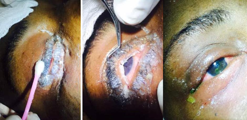 误把502胶水当作眼药水滴眼,502胶水怎么当眼药水