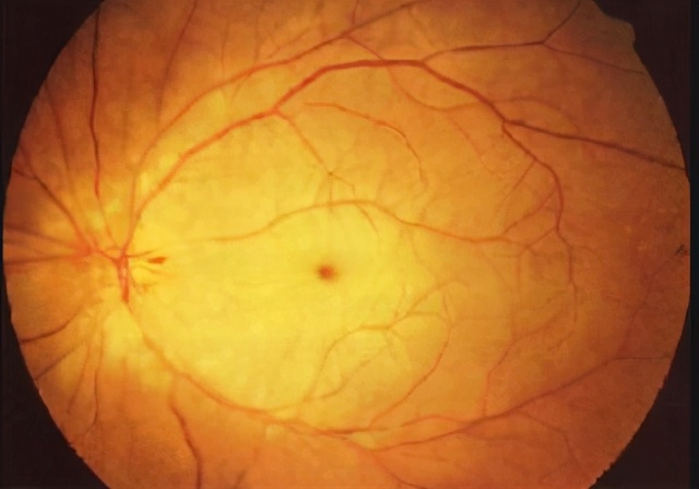 眼底静脉血管阻塞手术,眼底动脉阻塞康复治疗