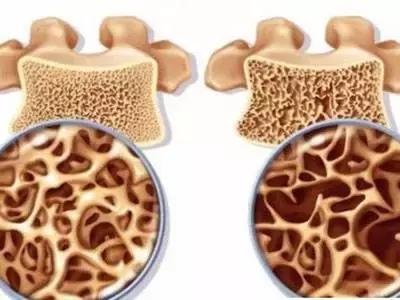 牛奶配钙片容易得肾结石吗,牛奶加芝士补钙效果更好吗
