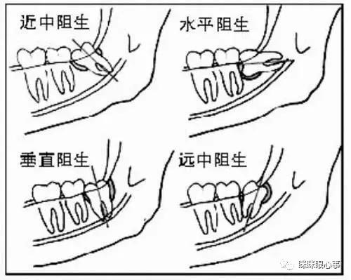 害怕恐惧拔智齿打麻醉,害怕拔智齿打针怎么克服