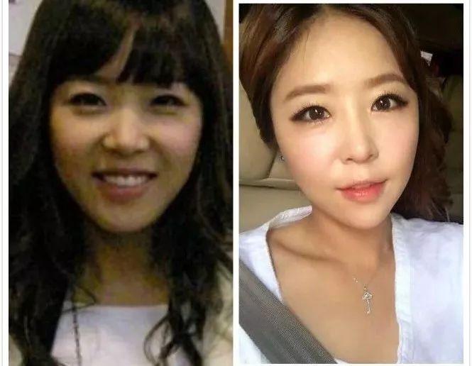 天后因队友吸du人气暴跌，公开承认整形却成蛇精下巴，瘦到脱相