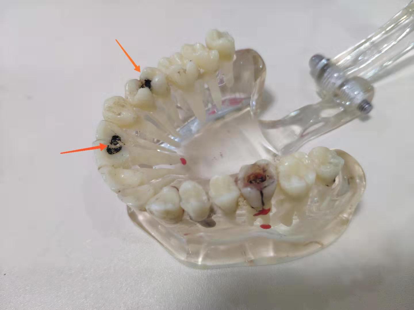 扉乐电动牙刷白色和粉色区别,扉乐电动牙刷不伤牙齿