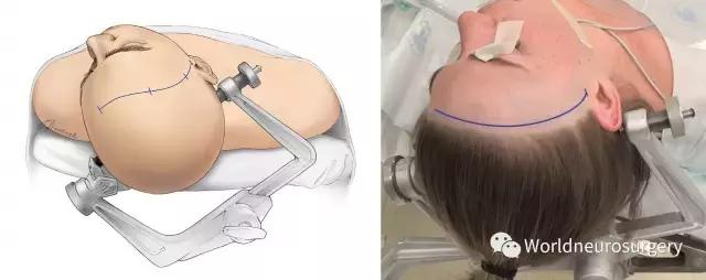 翼点入路技巧图解,翼点入路的开颅要点