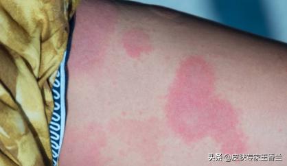 麻疹初期会出现皮肤痒吗,麻疹是不是有痒有疼