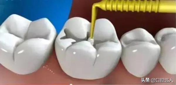 补牙能治好牙痛吗,补牙后为什么会越来越痛
