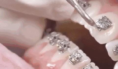 牙齿矫正后变黄怎么处理,矫正牙齿后牙齿为什么变黄了