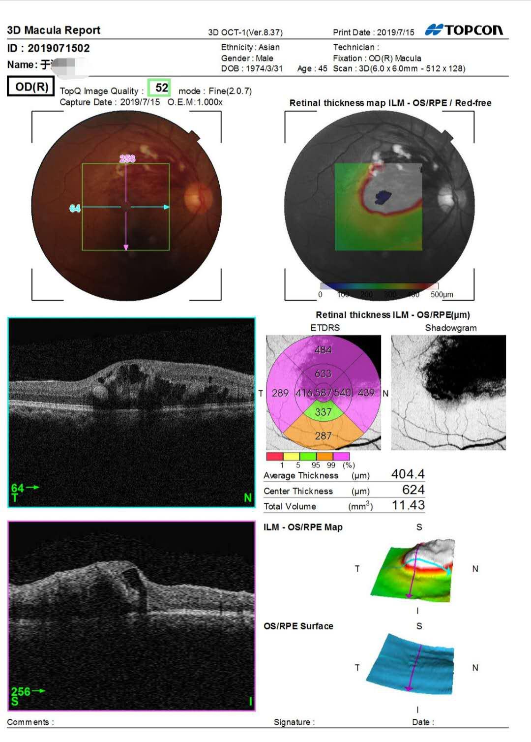 眼科先天性眼底病变,眼底病变医院