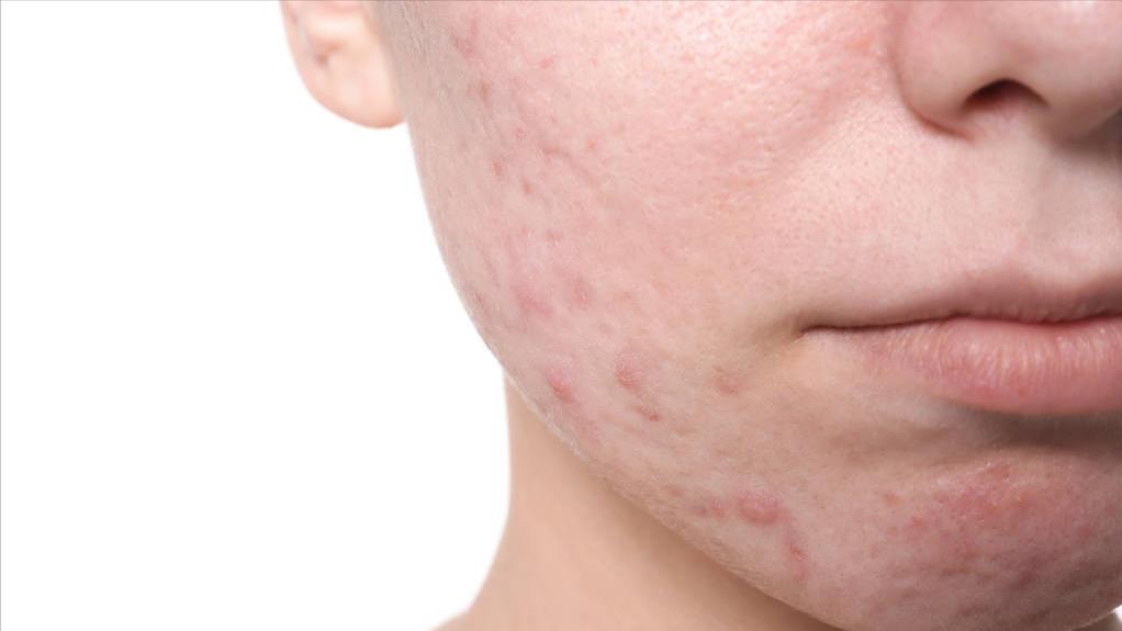 脸上反复长脓痘中医,脸长痘化脓有黄水怎么解决